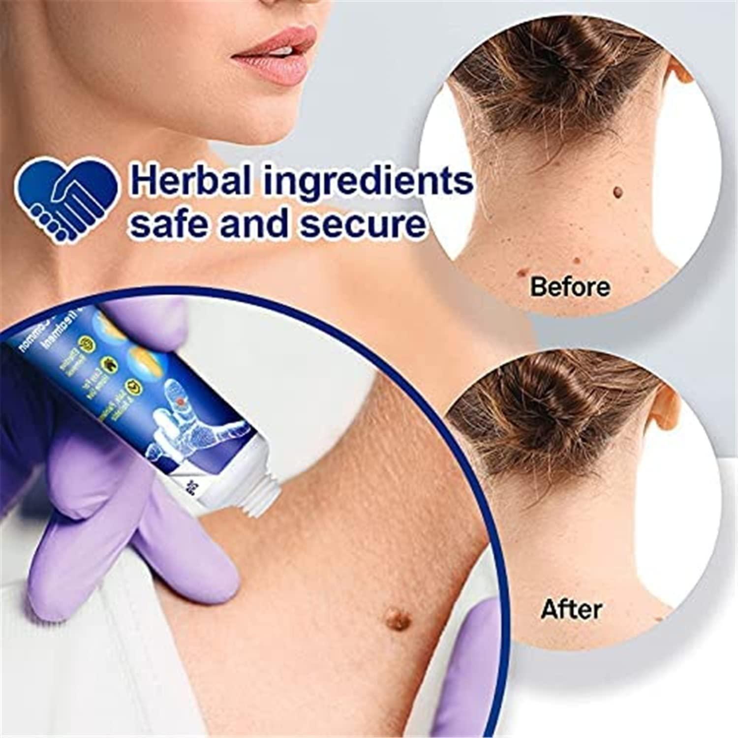 Wart Remover - Buy 1 Get 1 Free
